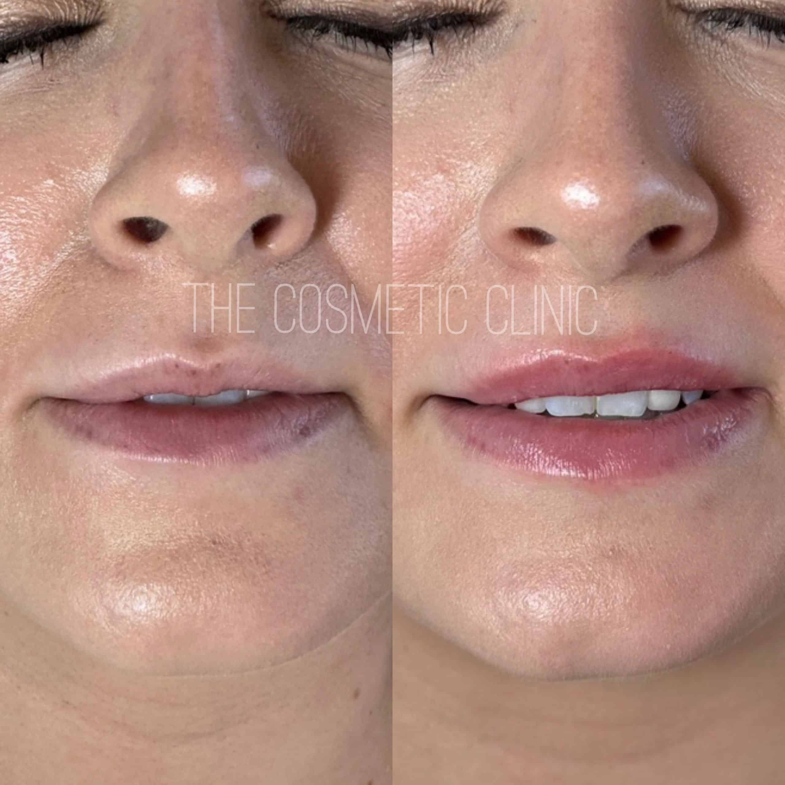Dermal Filler Before and After Photos | The Cosmetic Clinic in Greenwich, CT