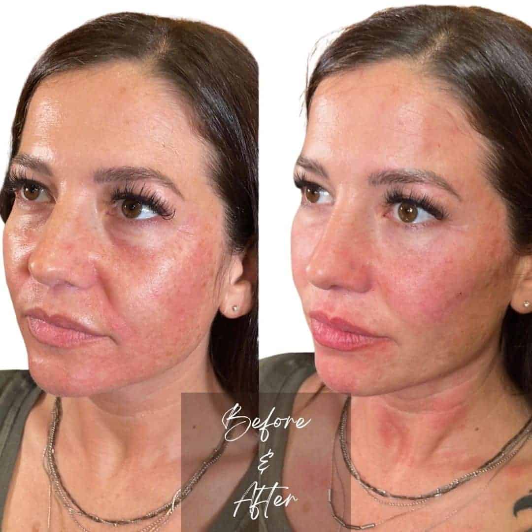 Female Dermal Filler Before and After Photos | The Cosmetic Clinic in Greenwich, CT