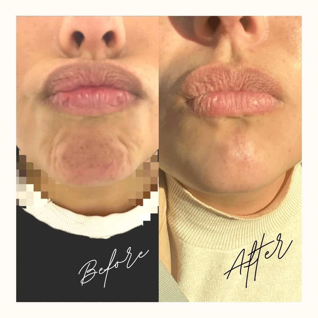 Female Lip Filler Before and After Photos | The Cosmetic Clinic in Greenwich, CT