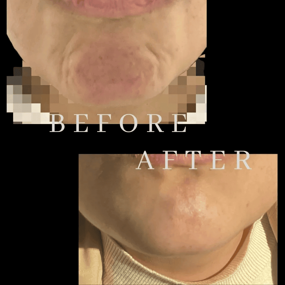 Before and After Treatment results | The Cosmetic Clinic in Greenwich, CT