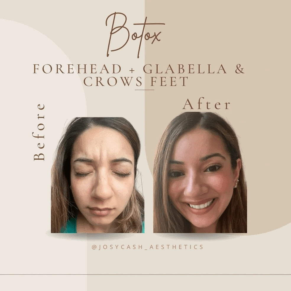 Female Botox Treatment Before and After Photos | The Cosmetic Clinic in Greenwich, CT