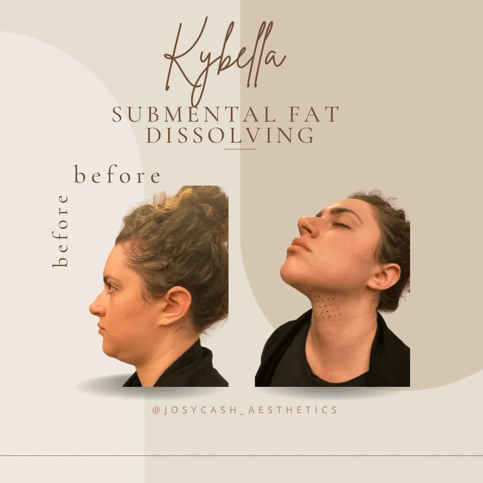 Female kybella Submental Fat Dissolving Before and After Photos | The Cosmetic Clinic in Greenwich, CT
