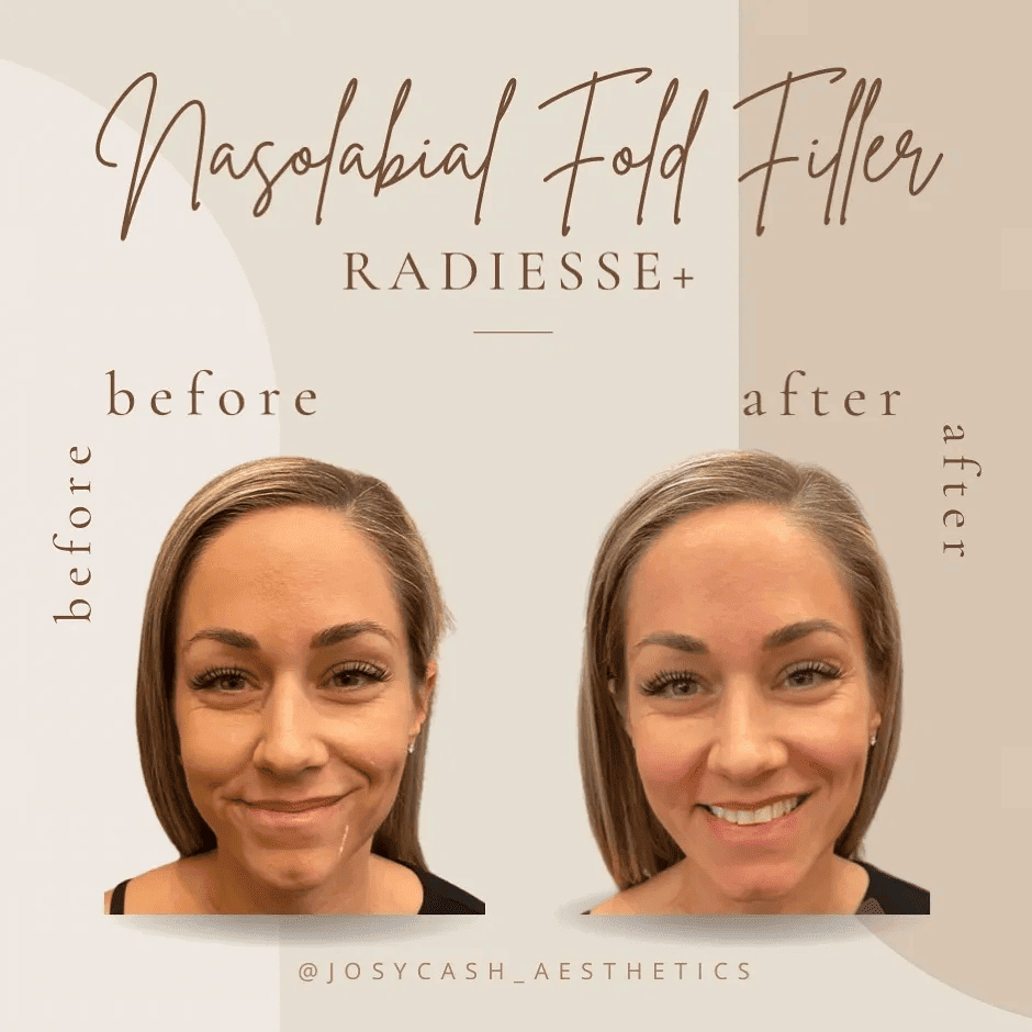 Female Nasolabial folds filler Before and After Photos | The Cosmetic Clinic in Greenwich, CT