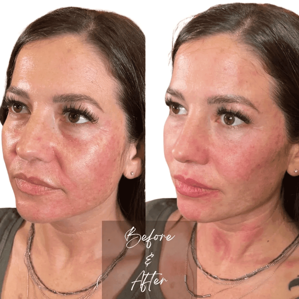 Before and After Treatment results | The Cosmetic Clinic in Greenwich, CT