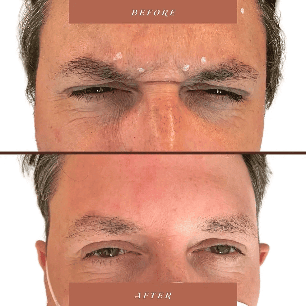 Before and After Botox Treatment results | The Cosmetic Clinic in Greenwich, CT