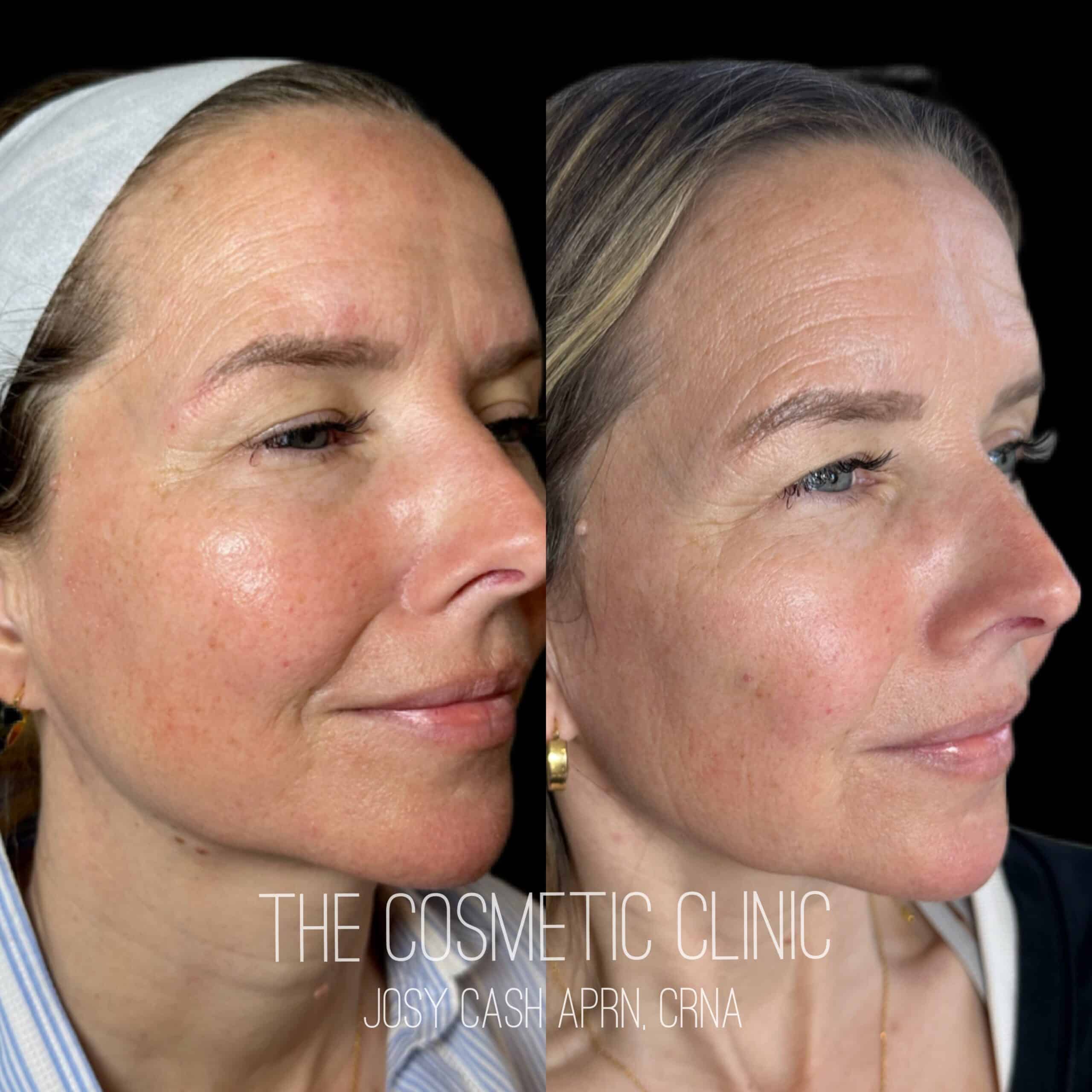 Female Dermal Filler Before and After Photos with The Cosmetic Clinic JOSY CASH APRN,CRNA | The Cosmetic Clinic in Greenwich, CT