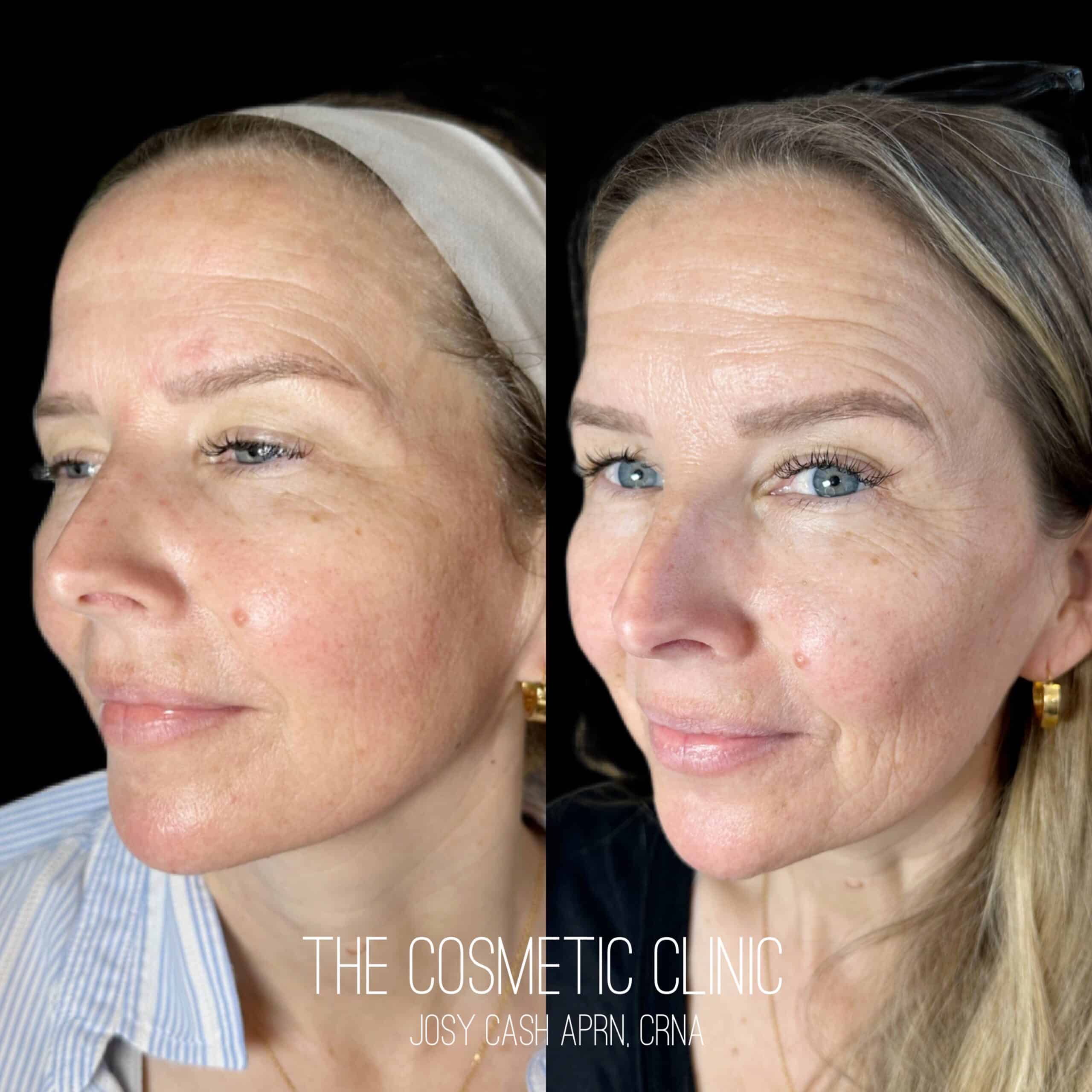 Female Dermal Filler Before and After Photos with The Cosmetic Clinic JOSY CASH APRN,CRNA | The Cosmetic Clinic in Greenwich, CT