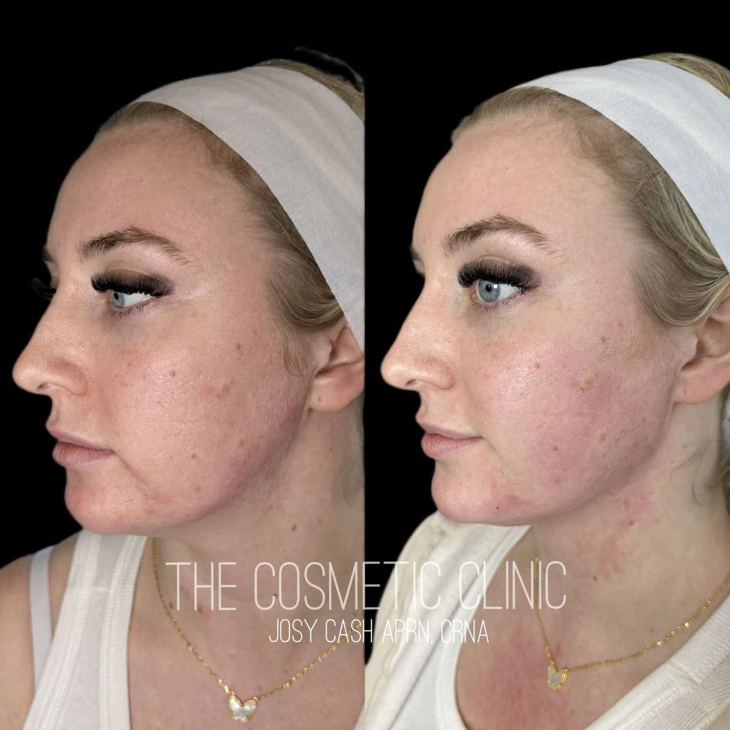 Female Dermal Filler Before and After Photos with The Cosmetic Clinic JOSY CASH APRN,CRNA The Cosmetic Clinic in Greenwich, CT
