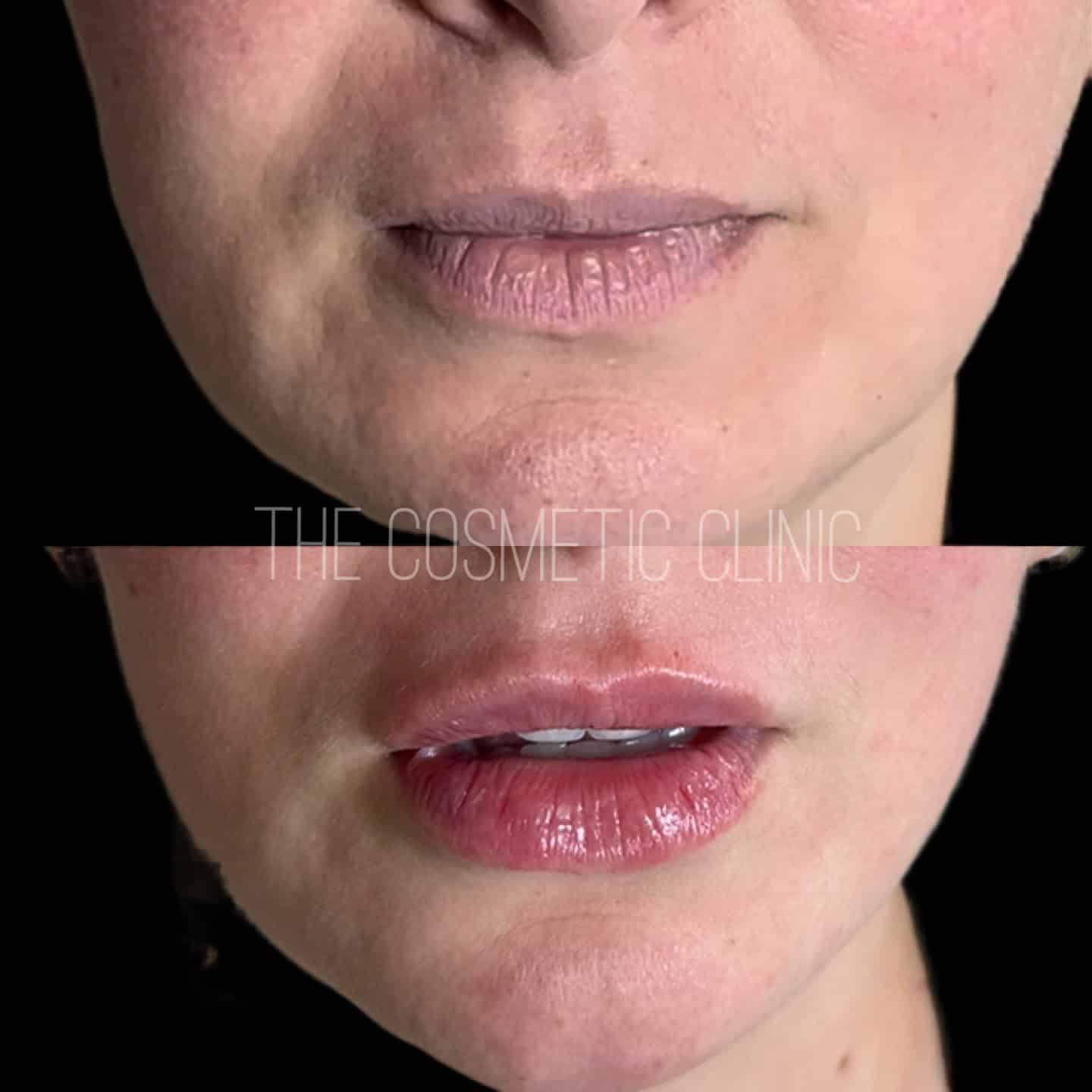 Female Dermal Filler Before and After Photos with The Cosmetic Clinic | The Cosmetic Clinic in Greenwich, CT