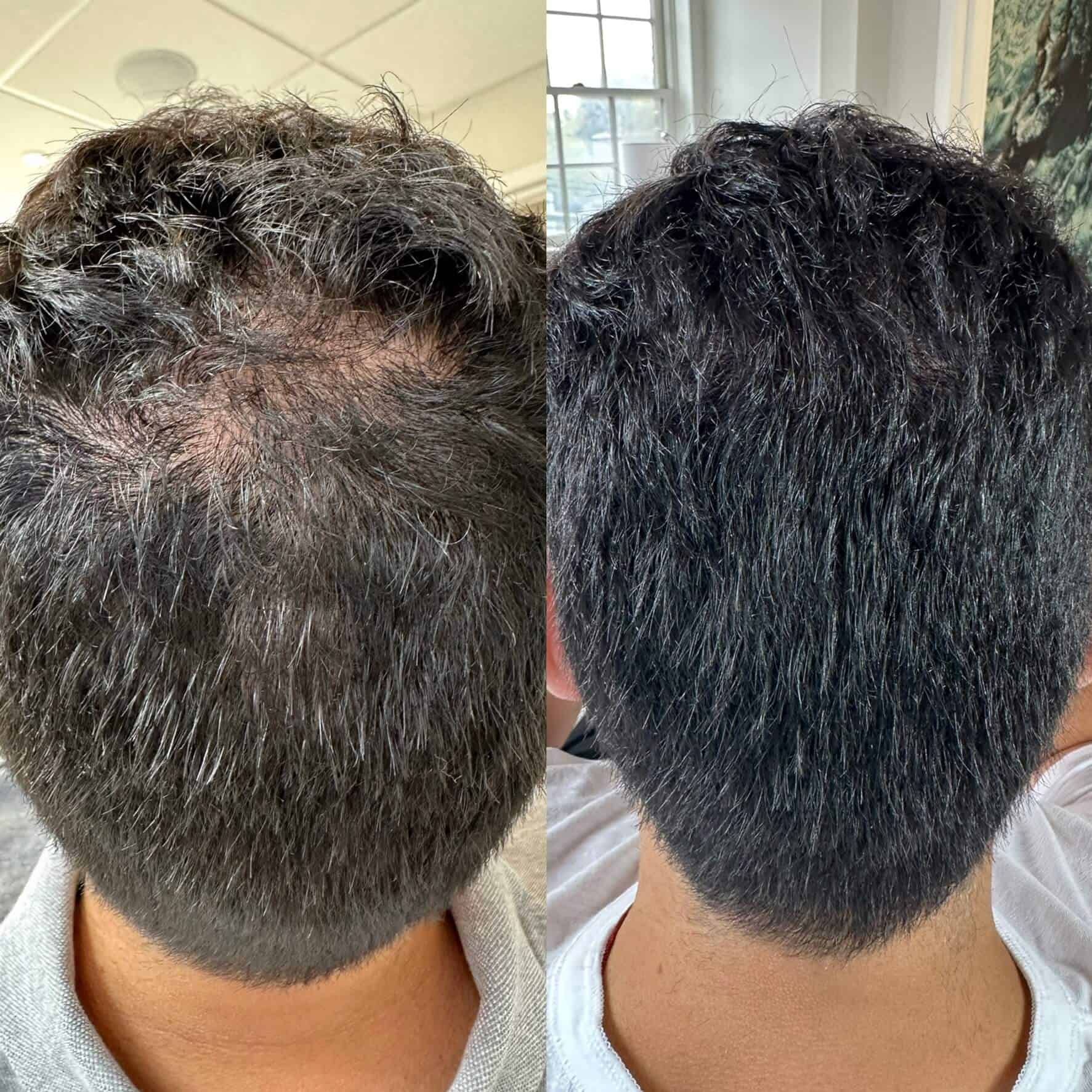 Man Before and After Hair Treatment photos | The Cosmetic Clinic in Greenwich, CT