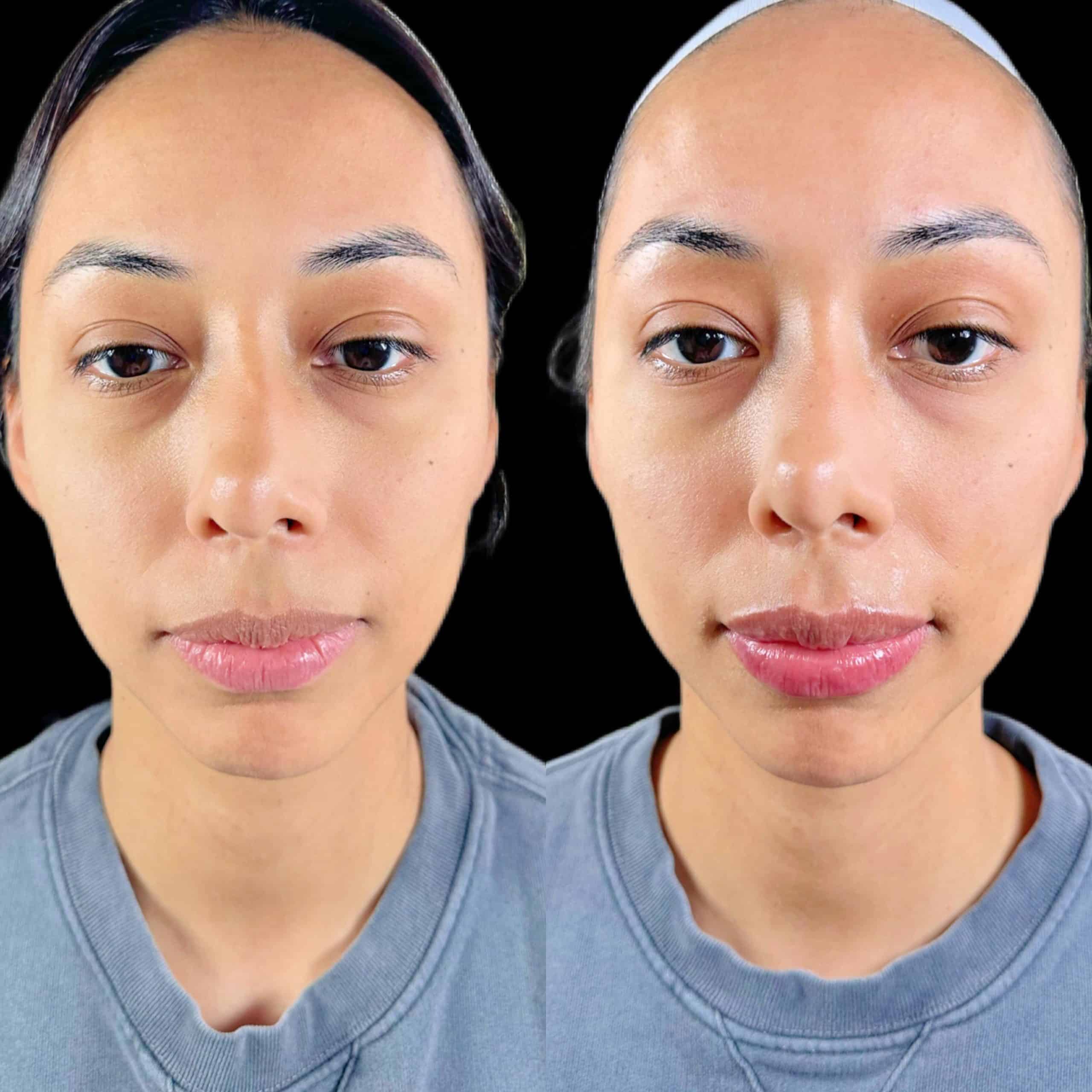 Woman Before and After lips Treatment photos | The Cosmetic Clinic in Greenwich, CT