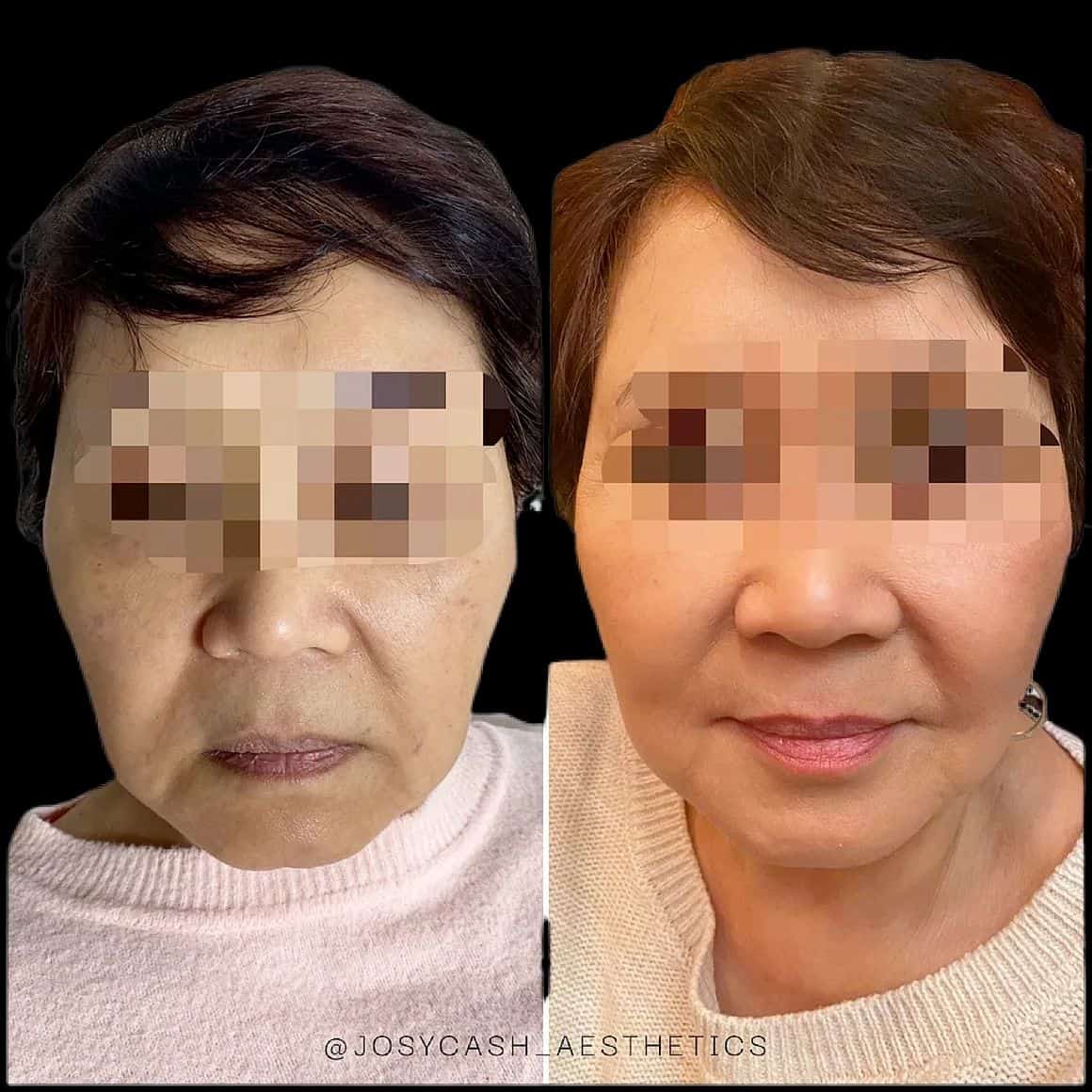 Before and After Treatment photo | The Cosmetic Clinic in Greenwich, CT