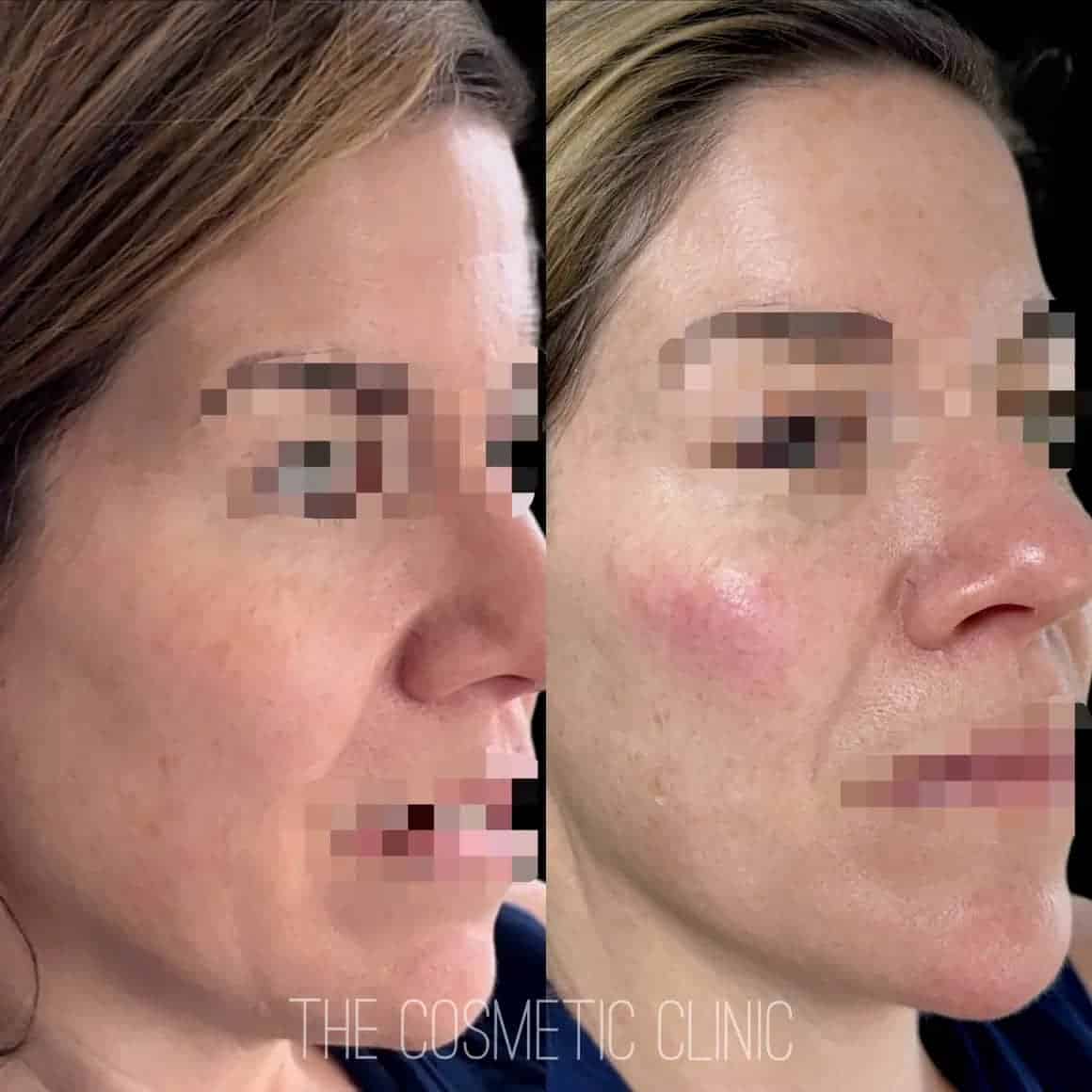 Woman Before and After Treatment photos | The Cosmetic Clinic in Greenwich, CT