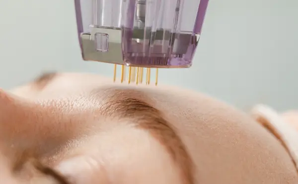 microneedling by The Cosmetic Clinic in Greenwich, CT
