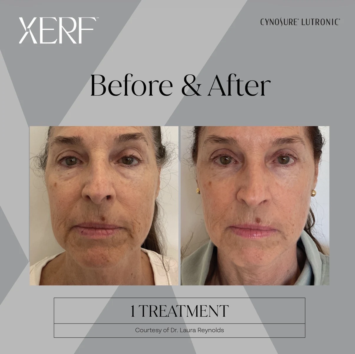 XERF™ Before and After Gallery (2)