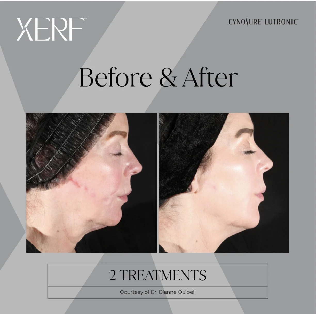 XERF™ Before and After Gallery
