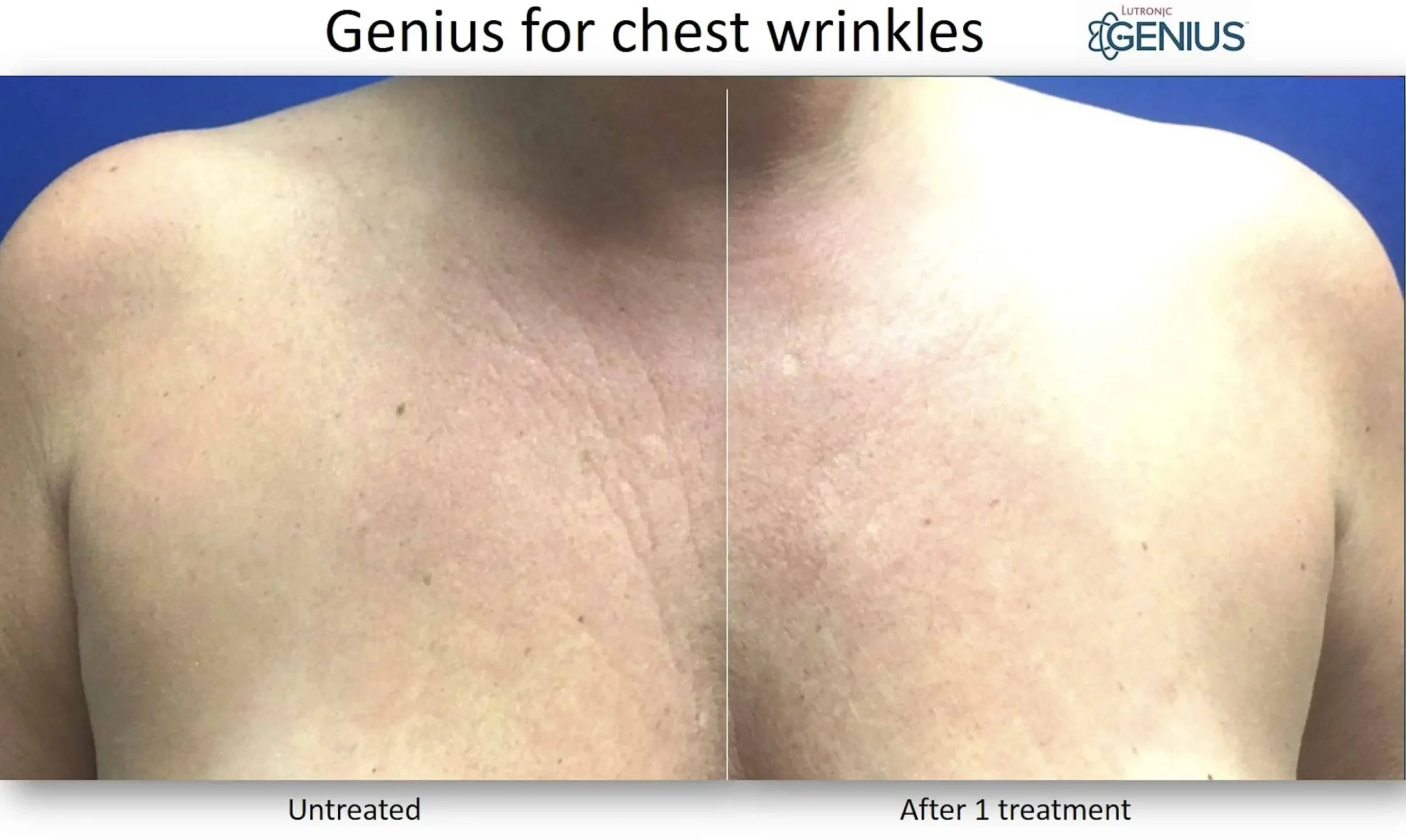 Chemical Peels by The Cosmetic Clinic in Greenwich, CT