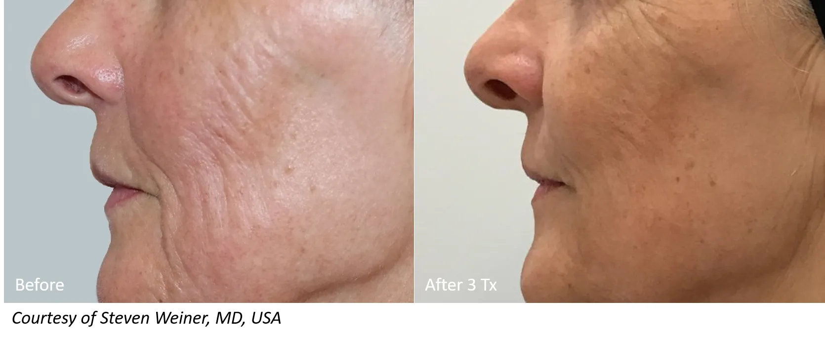 Face & Neck by The Cosmetic Clinic in Greenwich, CT
